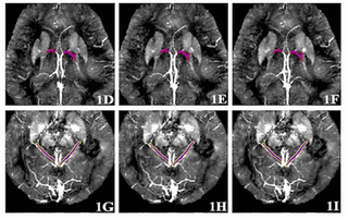 Científicos de la PNIU desarrollan un método de alta precisión para el diagnóstico temprano de la enfermedad de Alzheimer