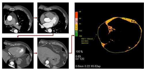 Computed tomography of the heart with analysis of epicardial fat using manual tracing of the epicardium on images - from the archive of researchers at the Research Institute of Cardiology of the Tomsk National Research Medical Center