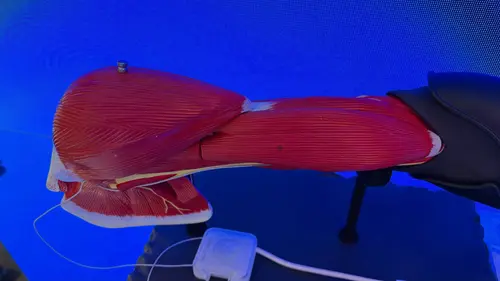 Los electrodos de la mano artificial están implantados en las terminaciones neuromusculares