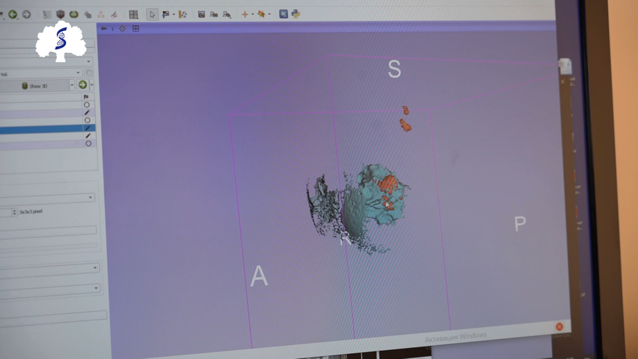 Interfaz del programa de modelado 3D preoperatorio. La patología tumoral se indica con un color diferente