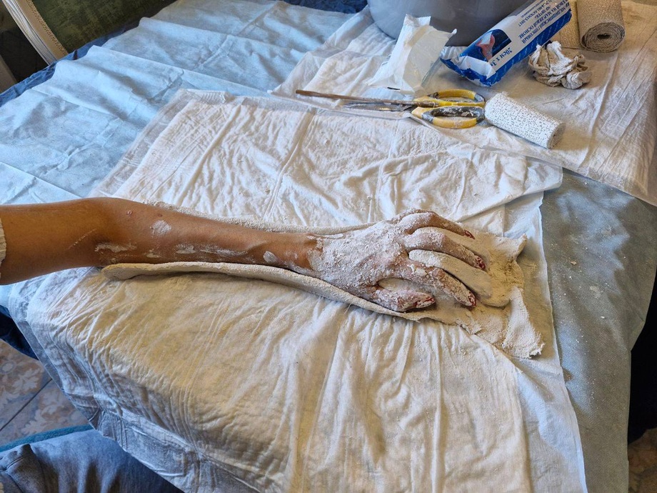 La fotografía fue tomada durante el proceso de obtención de un molde de yeso de la mano. En la contractura de flexión de la mano, la mano se encuentra en la posición de «pinza». Para diseñar la órtesis, es necesario tener un modelo 3D de la mano de la paciente en una posición extendida y natural. La paciente no puede mantener la mano en esta posición por sí sola, por lo que se utilizaron vendas de yeso